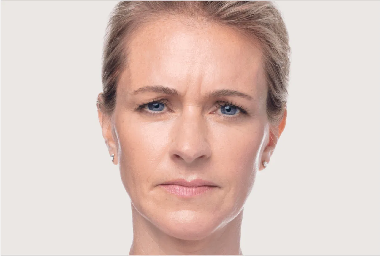 Dysport Before and After - Frown Lines