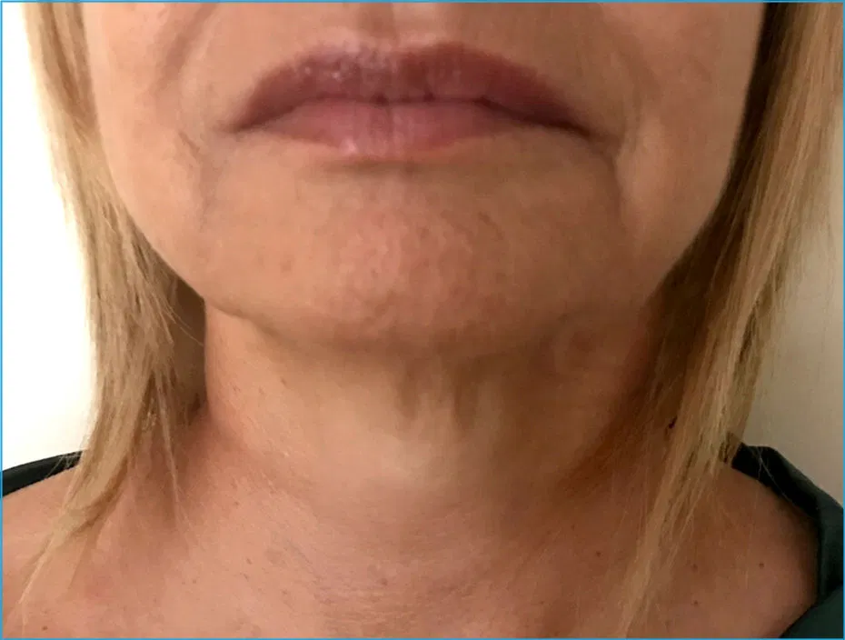Endolift Before and After - Jawline