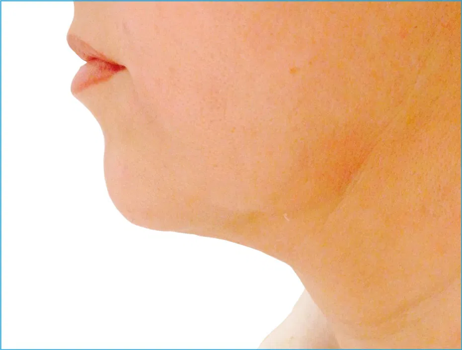 Endolift Before and After - Neck