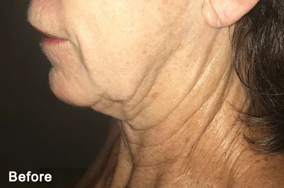 Morpheus8 Before and After - Skin Tightening