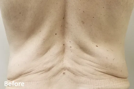 Morpheus8 Before and After - Acne Scars